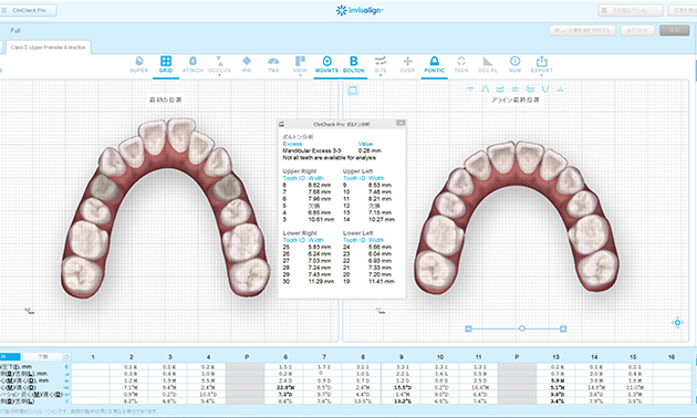 歯列全体の治療計画のシミュレーション『クリンチェック』