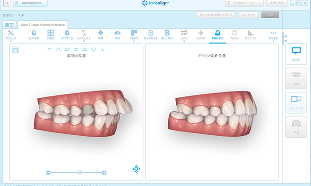 歯列全体の治療計画のシミュレーション『クリンチェック』